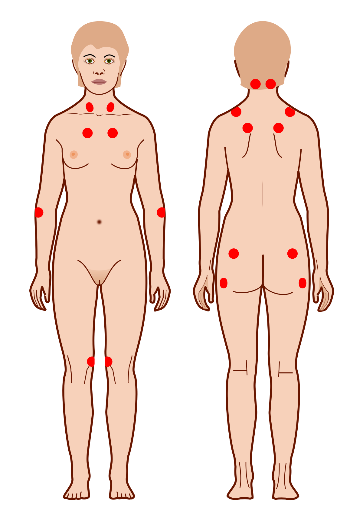Fibromyalgia Tocke